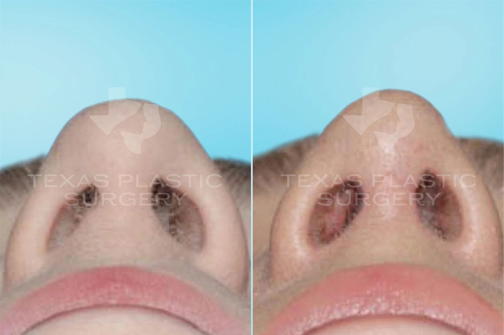 Real Patient results in San Antonio, TX Performed by Texas Plastic Surgery