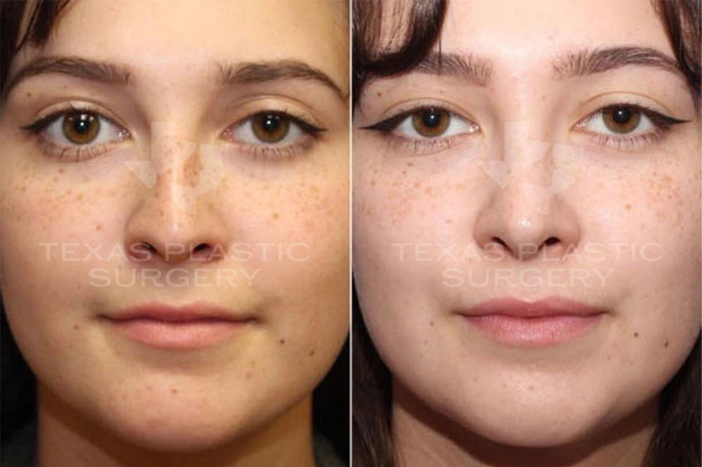 Real Patient results in San Antonio, TX Performed by Texas Plastic Surgery