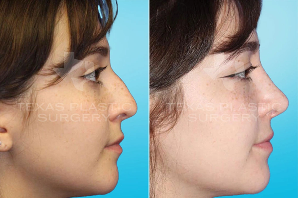 Real Patient results in San Antonio, TX Performed by Texas Plastic Surgery