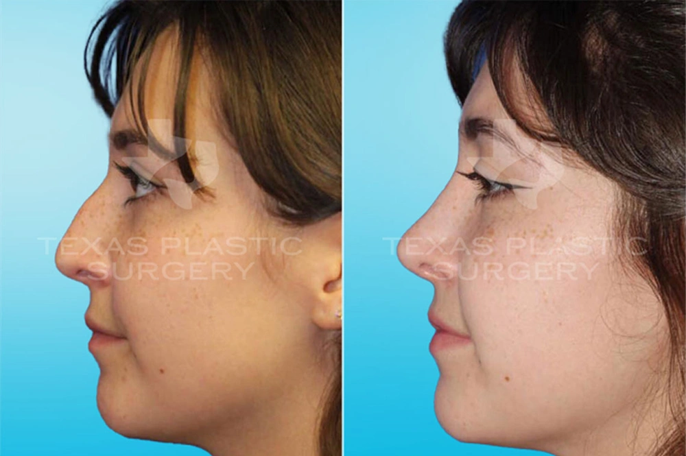 Real Patient results in San Antonio, TX Performed by Texas Plastic Surgery