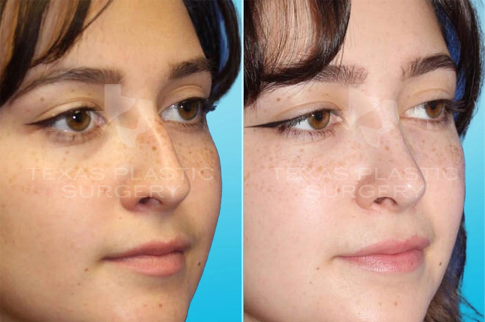 Real Patient results in San Antonio, TX Performed by Texas Plastic Surgery