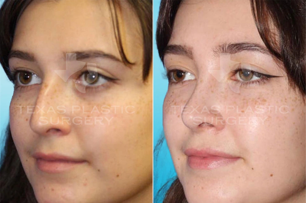 Real Patient results in San Antonio, TX Performed by Texas Plastic Surgery