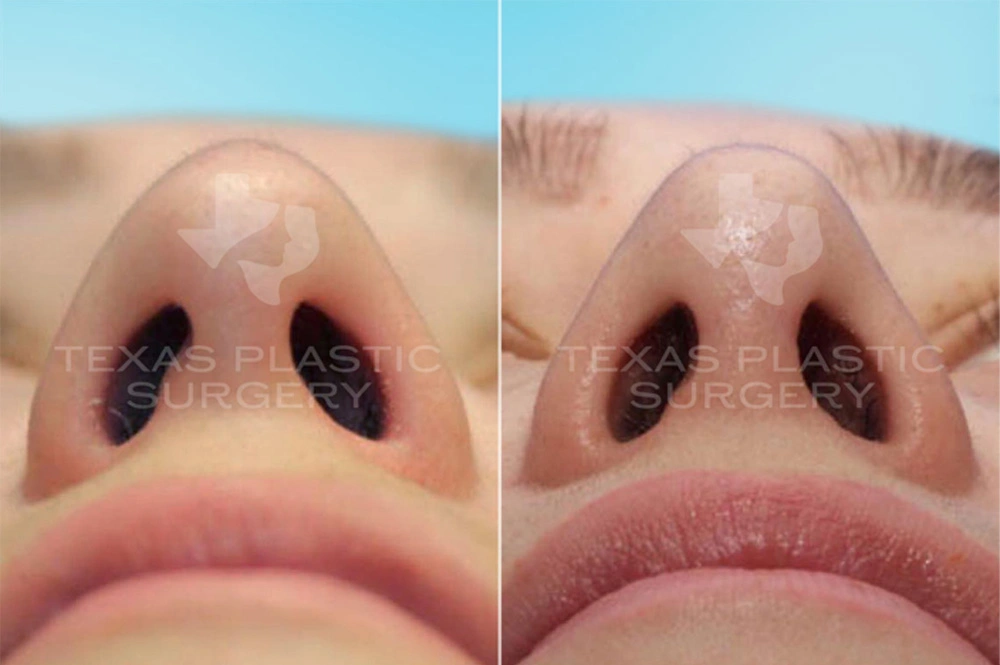 Real Patient results in San Antonio, TX Performed by Texas Plastic Surgery