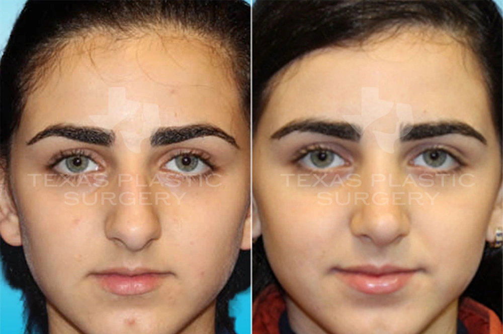 Real Patient results in San Antonio, TX Performed by Texas Plastic Surgery