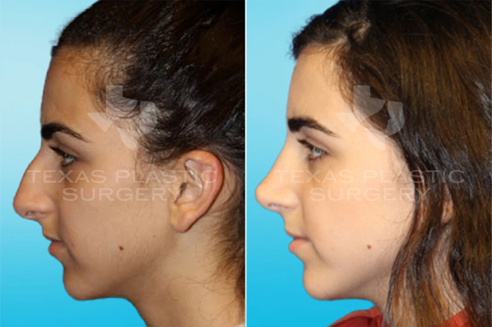 Real Patient results in San Antonio, TX Performed by Texas Plastic Surgery