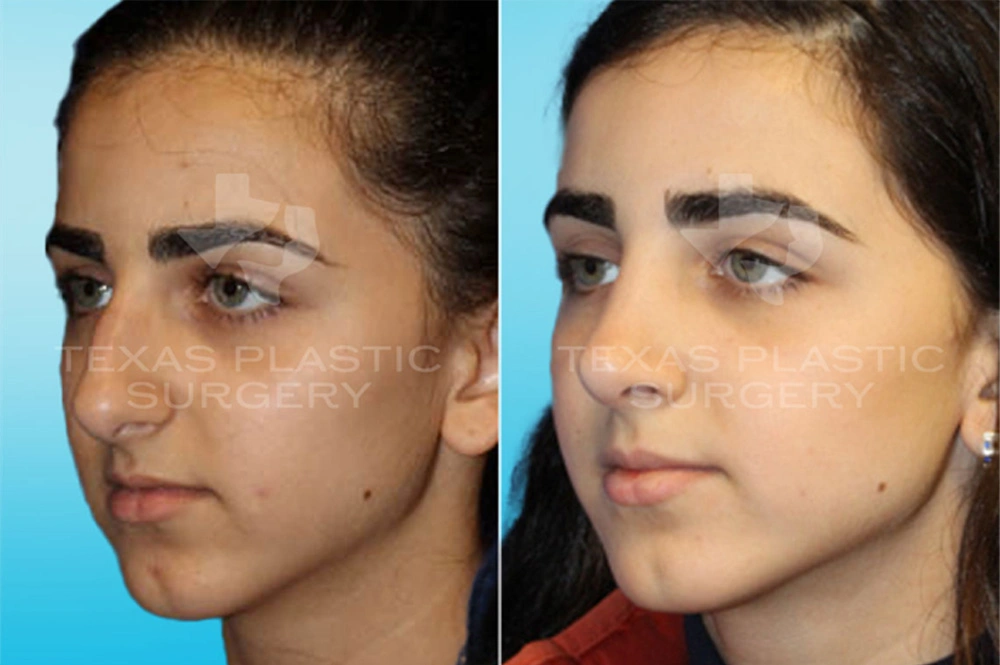 Real Patient results in San Antonio, TX Performed by Texas Plastic Surgery