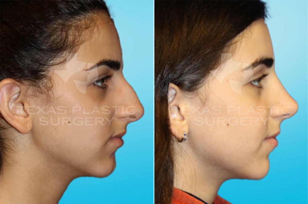 Real Patient results in San Antonio, TX Performed by Texas Plastic Surgery