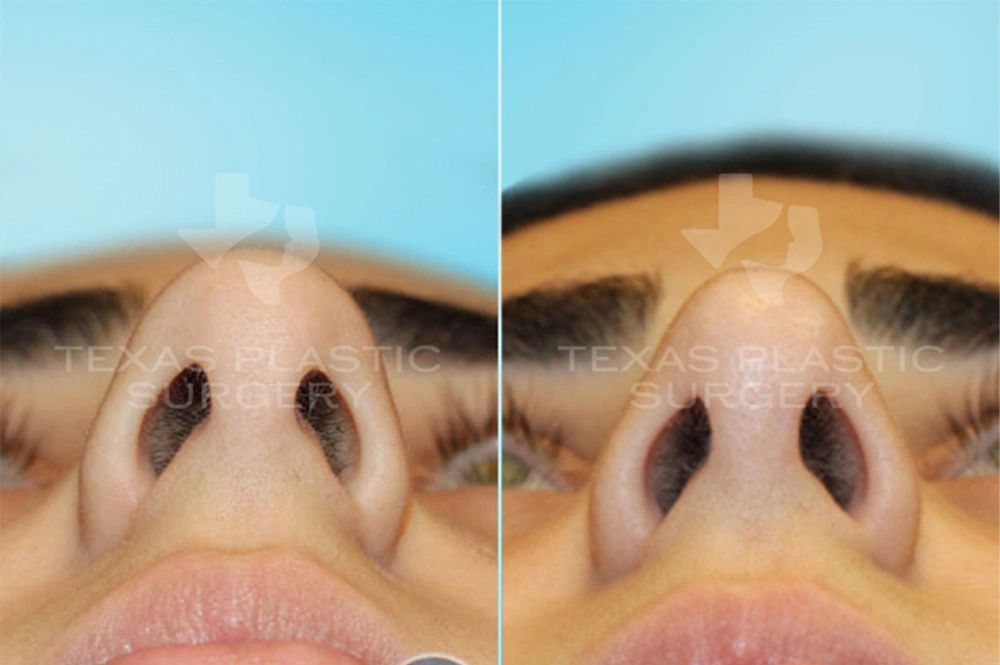 Real Patient results in San Antonio, TX Performed by Texas Plastic Surgery