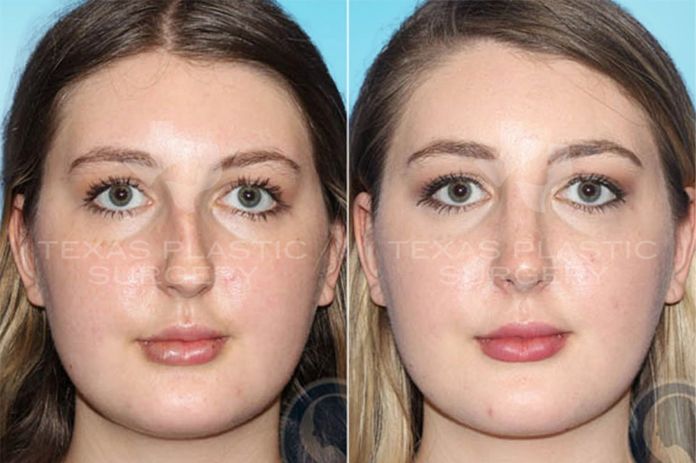 Real Patient results in San Antonio, TX Performed by Texas Plastic Surgery