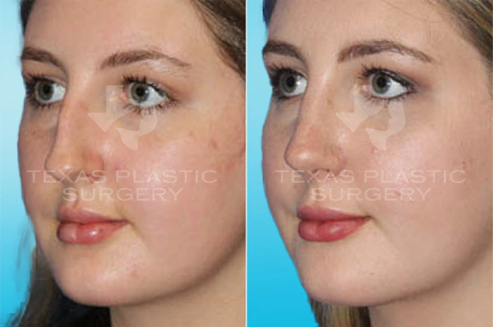 Real Patient results in San Antonio, TX Performed by Texas Plastic Surgery