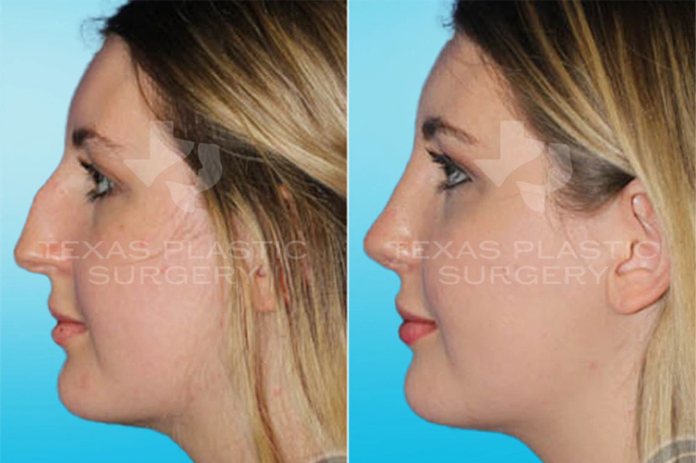 Real Patient results in San Antonio, TX Performed by Texas Plastic Surgery
