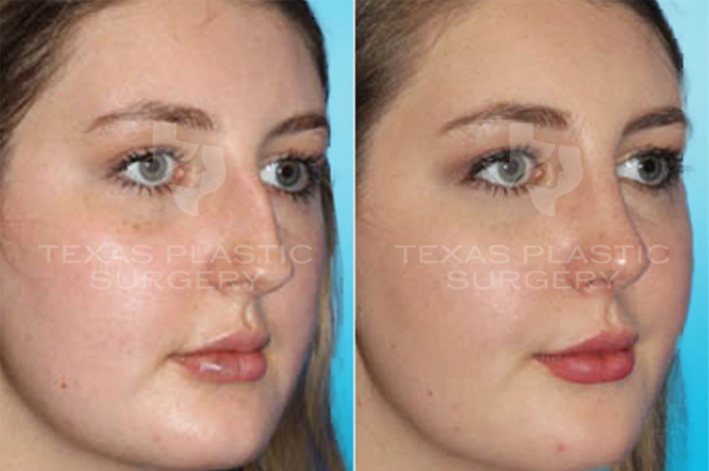 Real Patient results in San Antonio, TX Performed by Texas Plastic Surgery