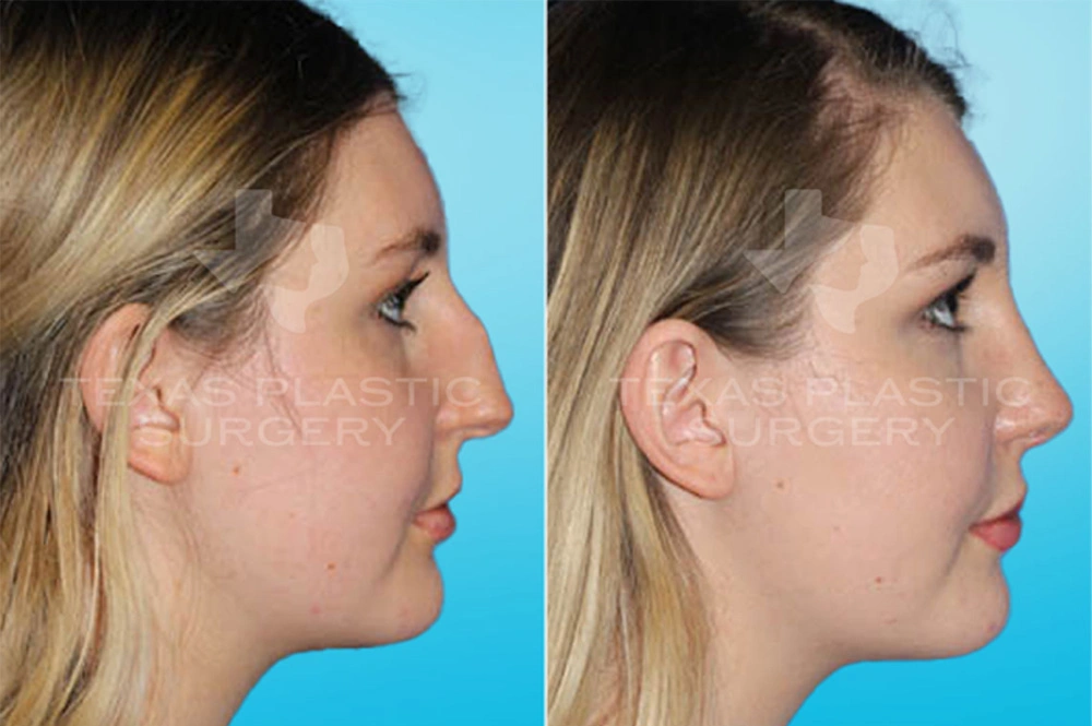 Real Patient results in San Antonio, TX Performed by Texas Plastic Surgery