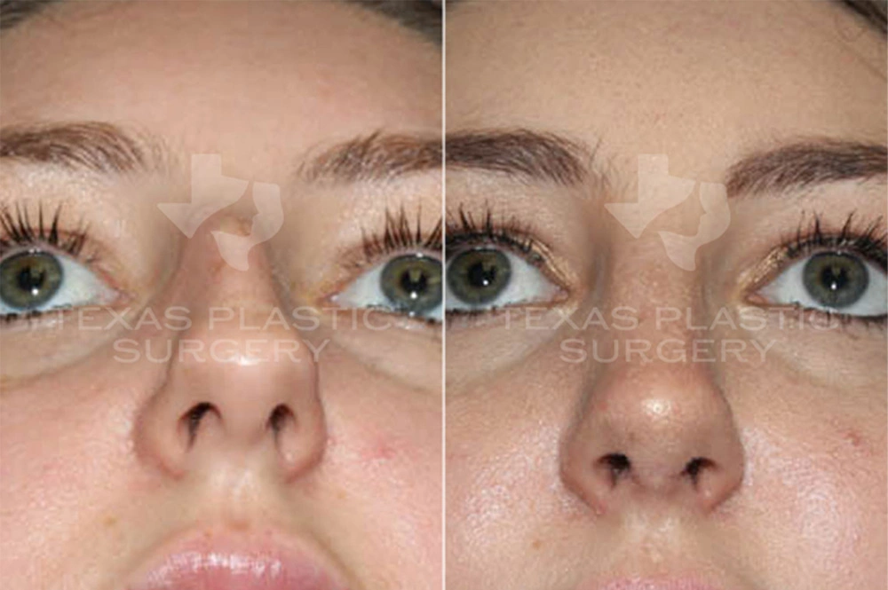 Real Patient results in San Antonio, TX Performed by Texas Plastic Surgery