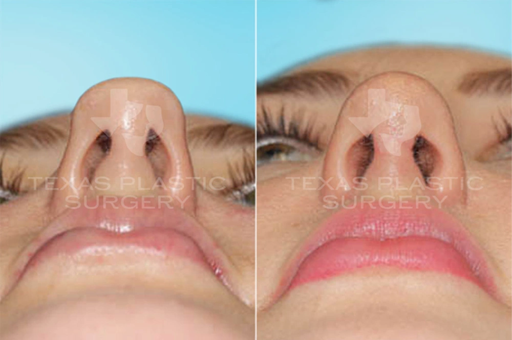 Real Patient results in San Antonio, TX Performed by Texas Plastic Surgery