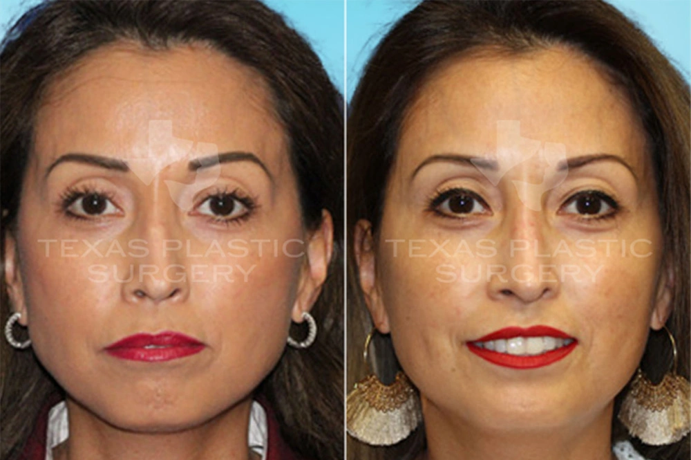 Real Patient results in San Antonio, TX Performed by Texas Plastic Surgery