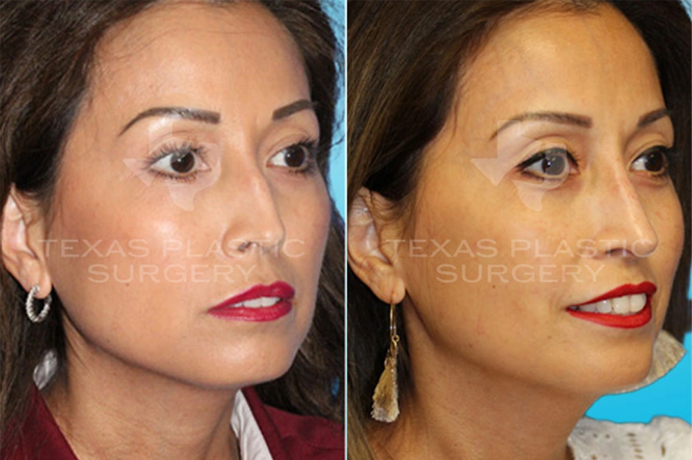 Real Patient results in San Antonio, TX Performed by Texas Plastic Surgery