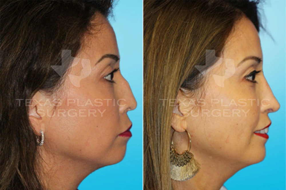 Real Patient results in San Antonio, TX Performed by Texas Plastic Surgery