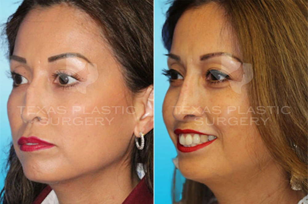 Real Patient results in San Antonio, TX Performed by Texas Plastic Surgery