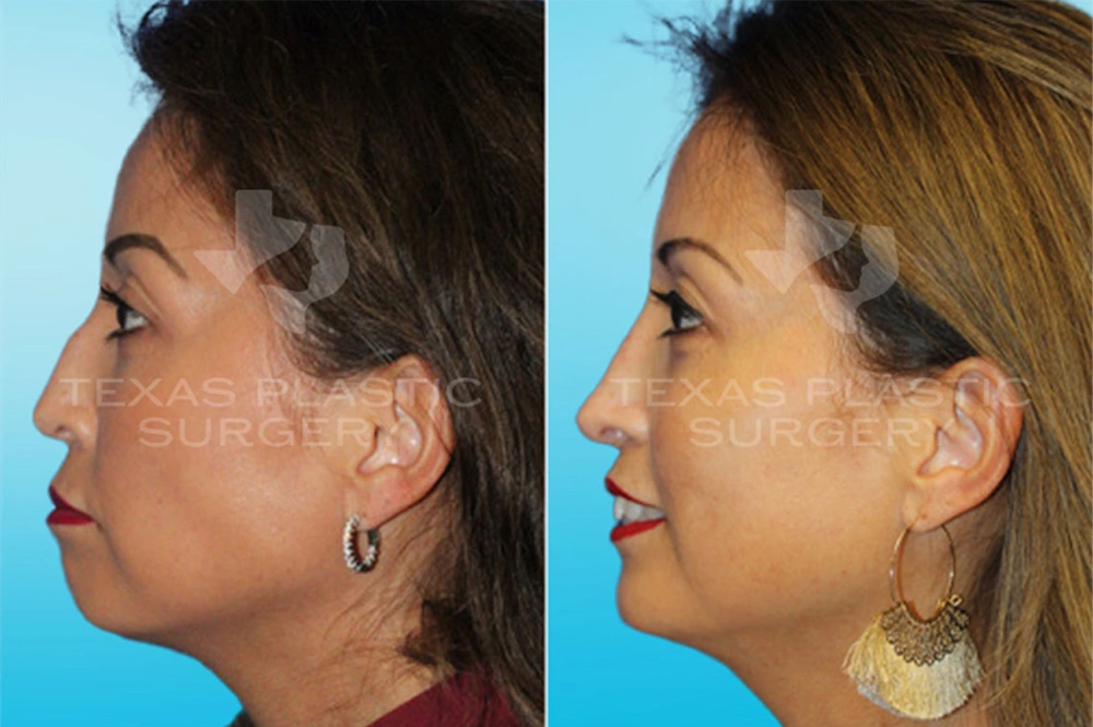 Real Patient results in San Antonio, TX Performed by Texas Plastic Surgery