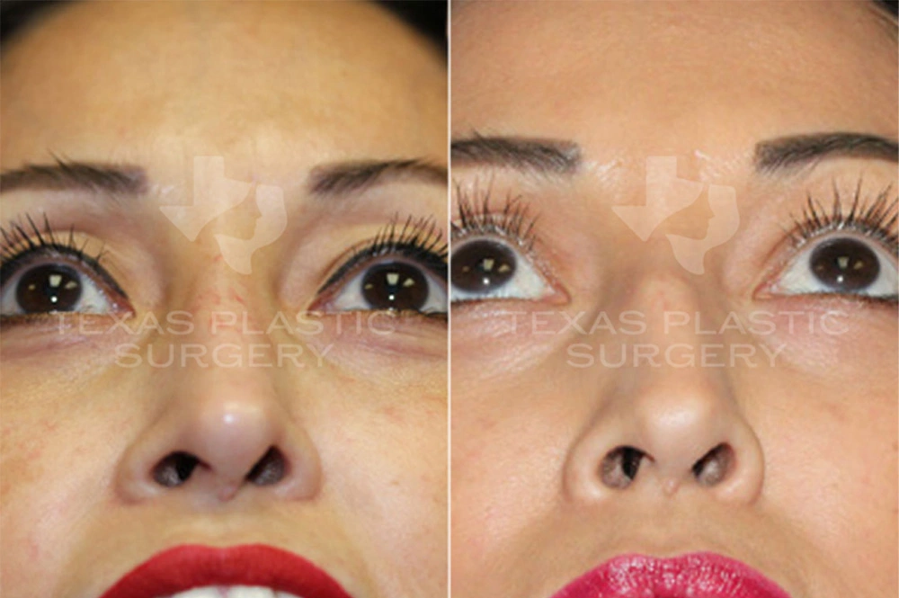 Real Patient results in San Antonio, TX Performed by Texas Plastic Surgery