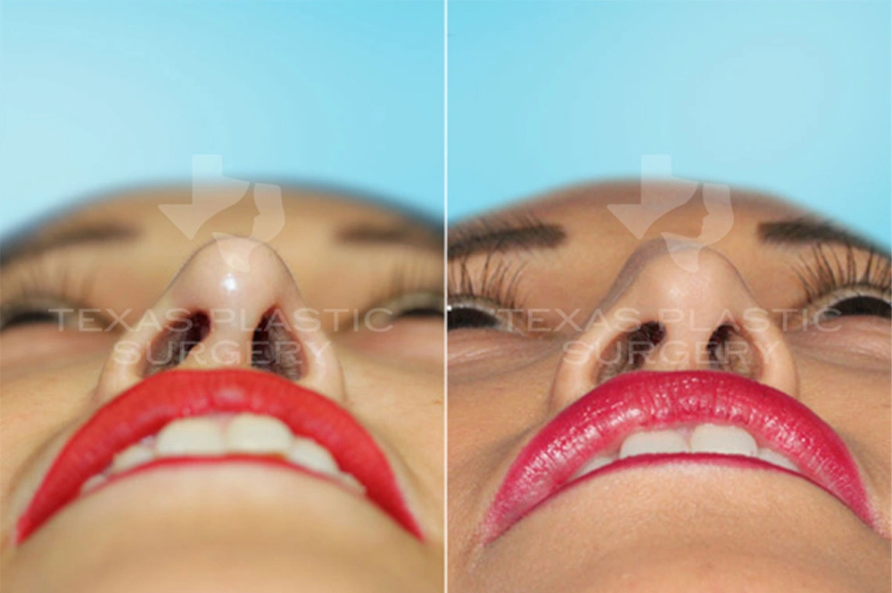 Real Patient results in San Antonio, TX Performed by Texas Plastic Surgery