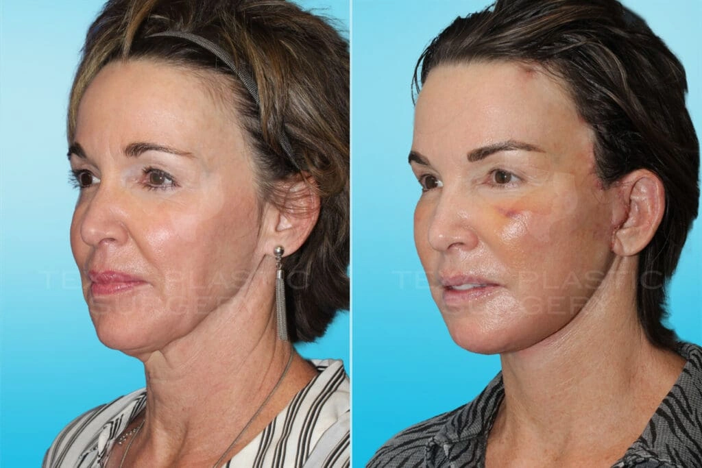 Real Patient results in San Antonio, TX Performed by Texas Plastic Surgery