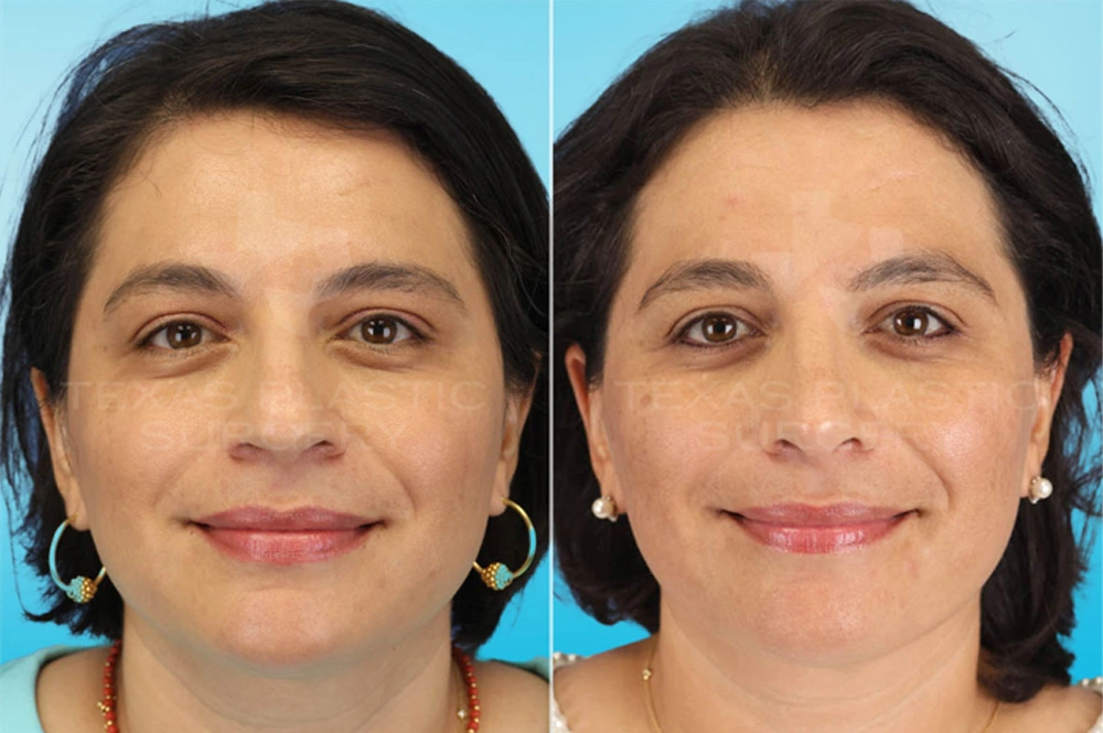 Real Patient results in San Antonio, TX Performed by Texas Plastic Surgery