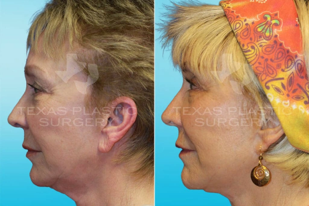 Real Patient results in San Antonio, TX Performed by Texas Plastic Surgery