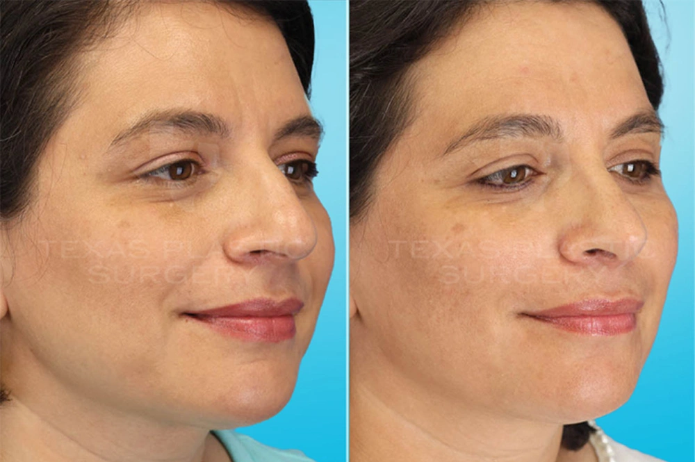 Real Patient results in San Antonio, TX Performed by Texas Plastic Surgery
