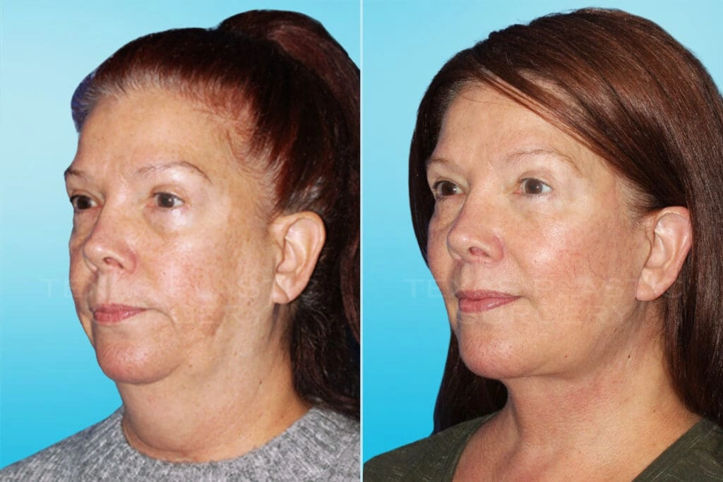 Real Patient results in San Antonio, TX Performed by Texas Plastic Surgery