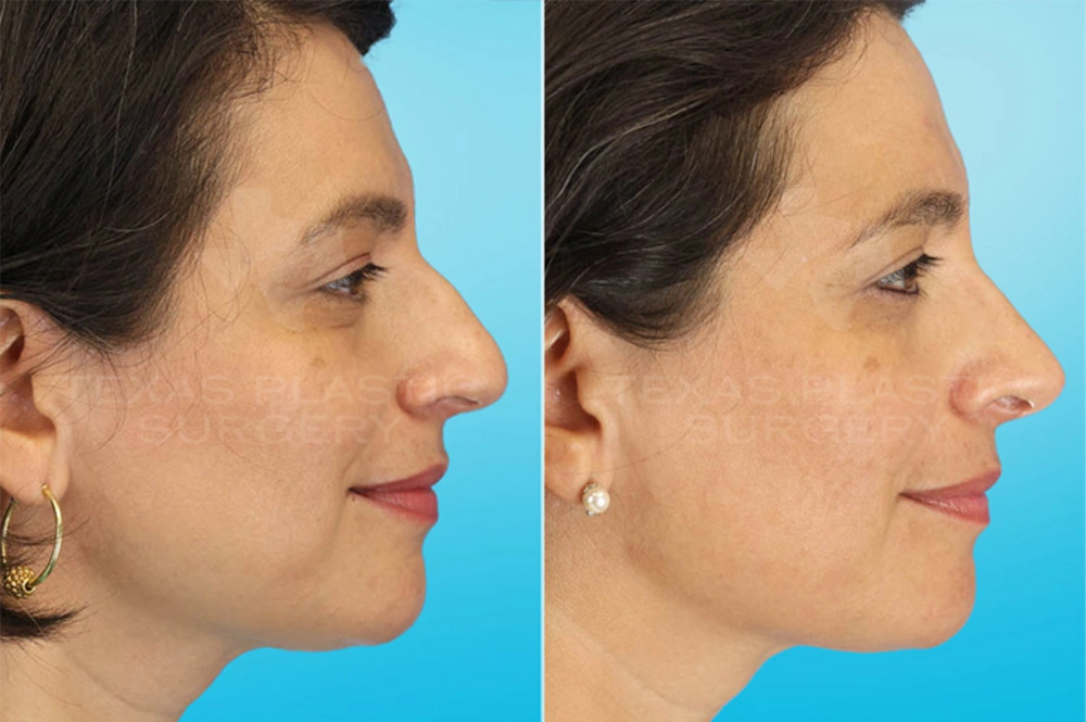 Real Patient results in San Antonio, TX Performed by Texas Plastic Surgery