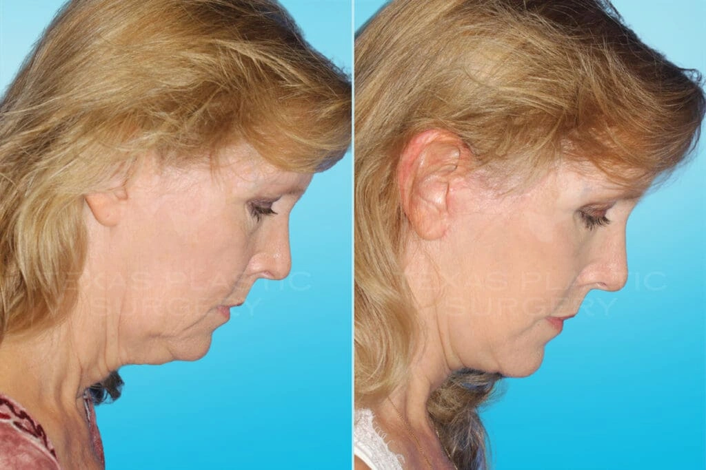 Real Patient results in San Antonio, TX Performed by Texas Plastic Surgery