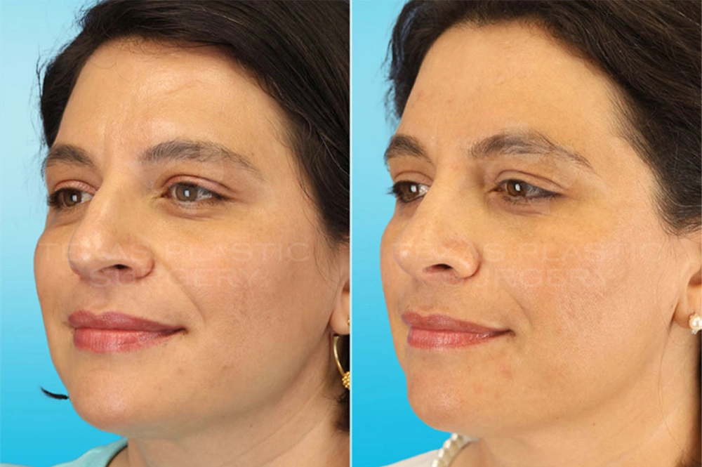 Real Patient results in San Antonio, TX Performed by Texas Plastic Surgery