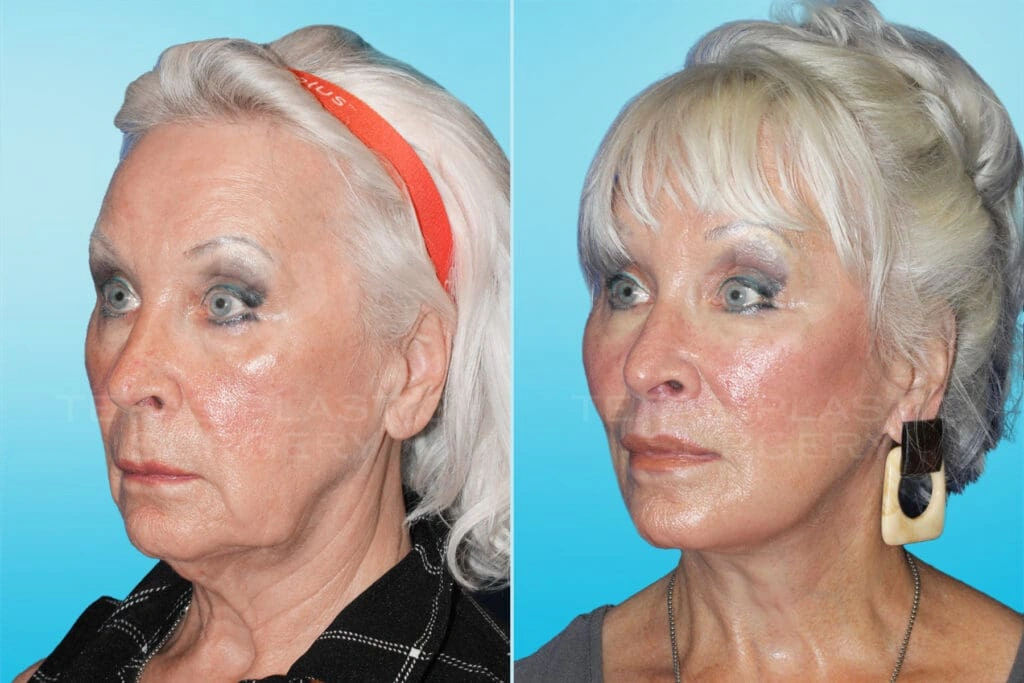 Real Patient results in San Antonio, TX Performed by Texas Plastic Surgery