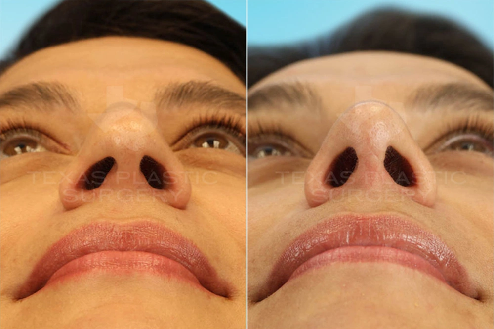 Real Patient results in San Antonio, TX Performed by Texas Plastic Surgery