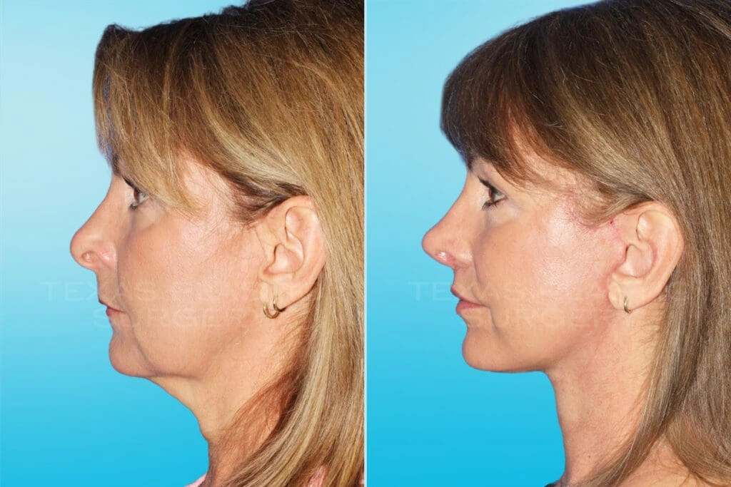Real Patient results in San Antonio, TX Performed by Texas Plastic Surgery