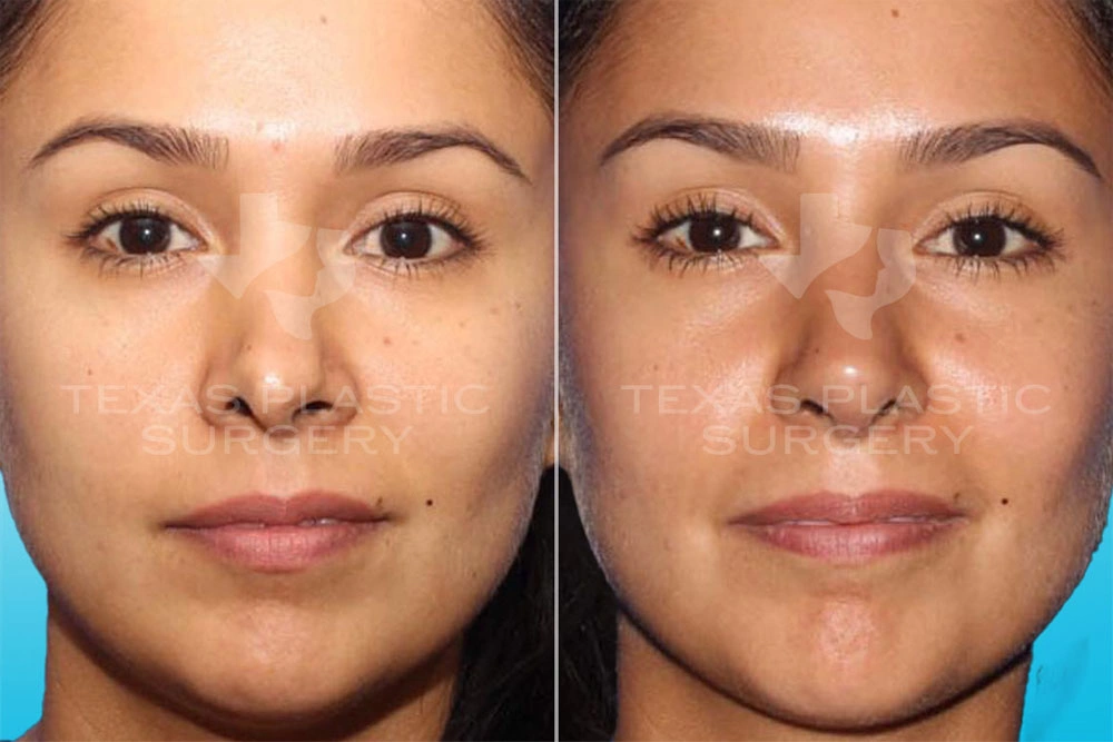 Real Patient results in San Antonio, TX Performed by Texas Plastic Surgery