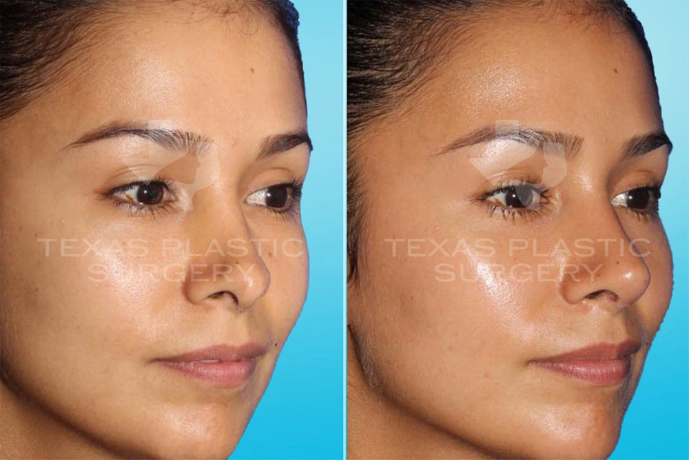Real Patient results in San Antonio, TX Performed by Texas Plastic Surgery