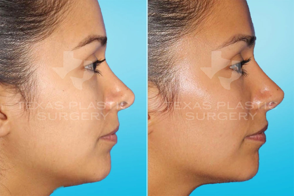 Real Patient results in San Antonio, TX Performed by Texas Plastic Surgery