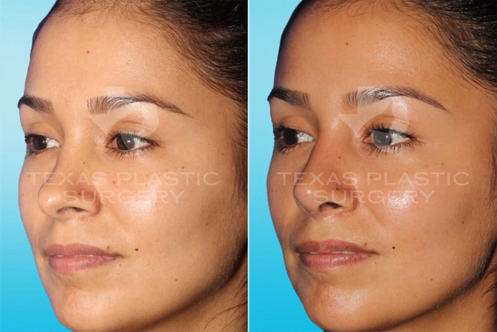 Real Patient results in San Antonio, TX Performed by Texas Plastic Surgery