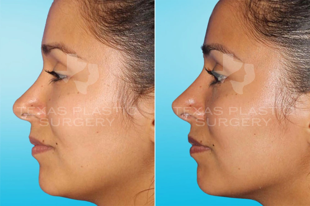 Real Patient results in San Antonio, TX Performed by Texas Plastic Surgery