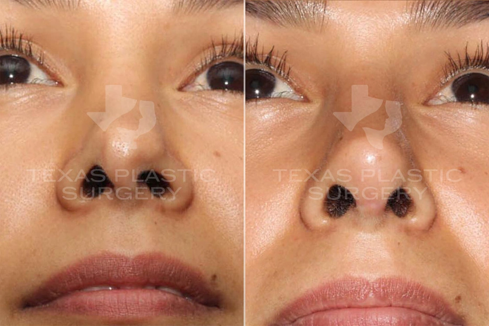 Real Patient results in San Antonio, TX Performed by Texas Plastic Surgery