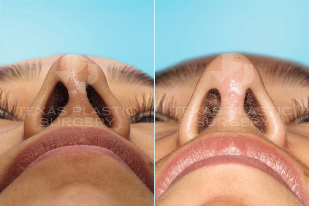 Real Patient results in San Antonio, TX Performed by Texas Plastic Surgery