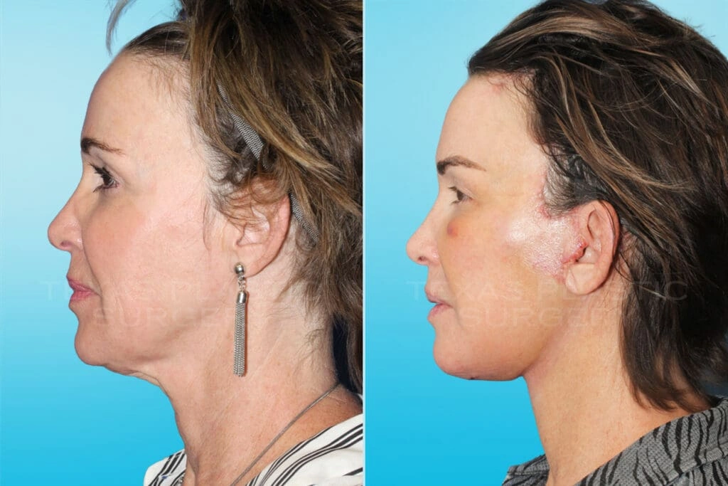 Real Patient results in San Antonio, TX Performed by Texas Plastic Surgery