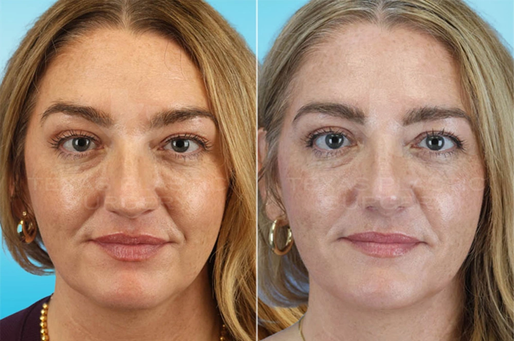 Real Patient results in San Antonio, TX Performed by Texas Plastic Surgery