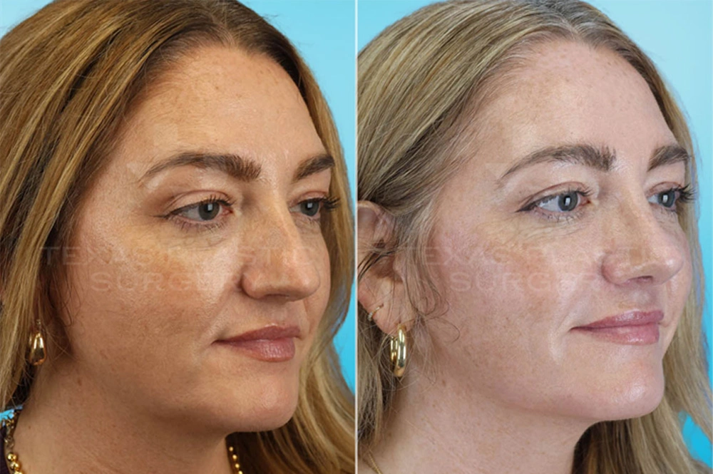 Real Patient results in San Antonio, TX Performed by Texas Plastic Surgery