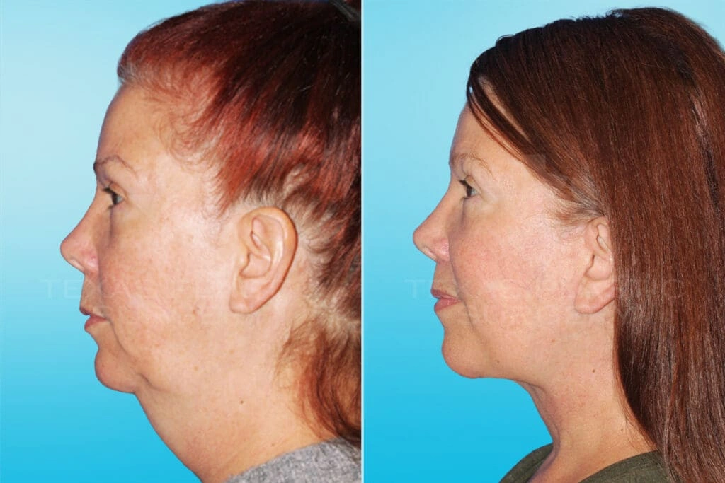 Real Patient results in San Antonio, TX Performed by Texas Plastic Surgery