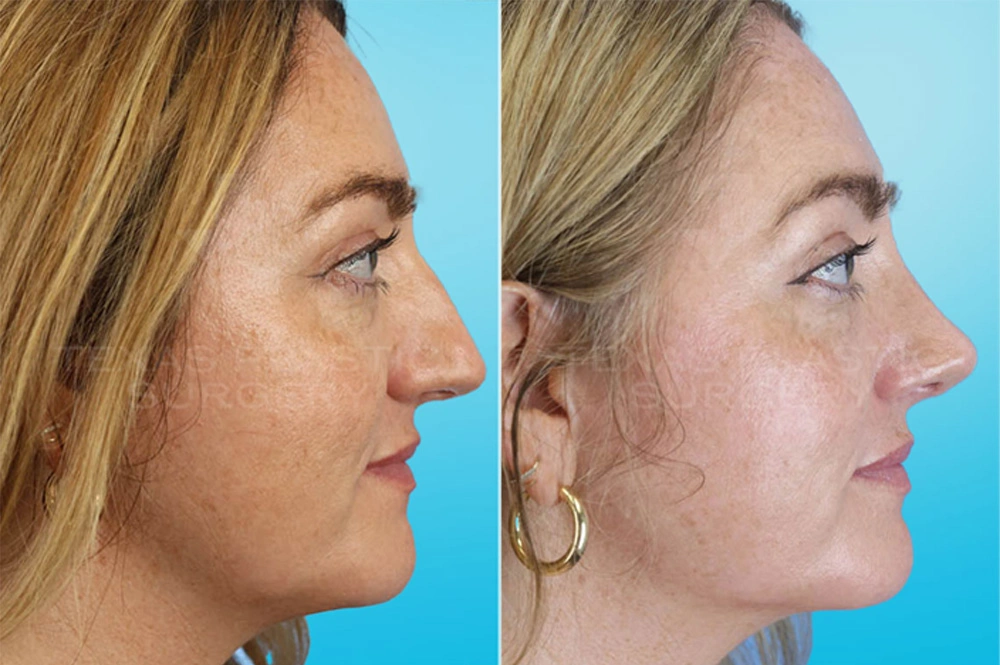 Real Patient results in San Antonio, TX Performed by Texas Plastic Surgery