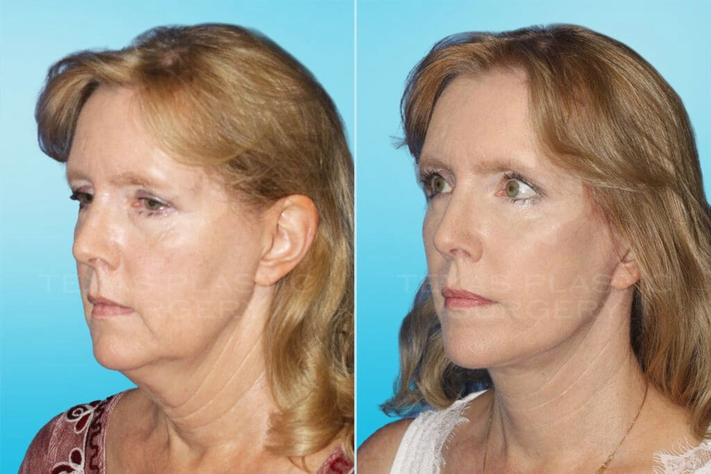 Real Patient results in San Antonio, TX Performed by Texas Plastic Surgery